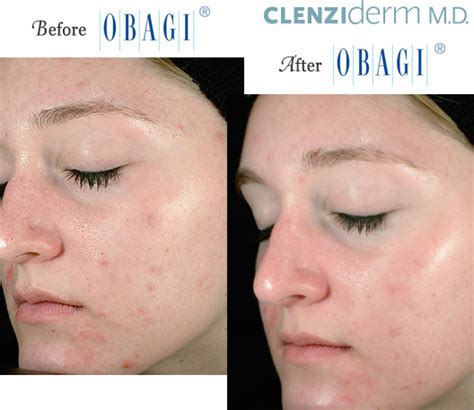 Obagi® Before and After Pictures – Micki Ly M.D. Maui Dermatologist