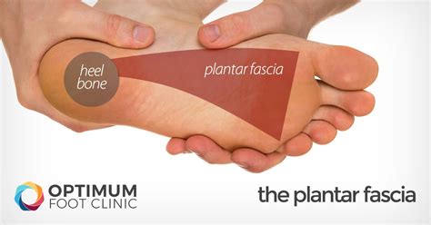 Plantar Fasciitis - Heel Pain Explained - Optimum Foot Clinic - Expert ...