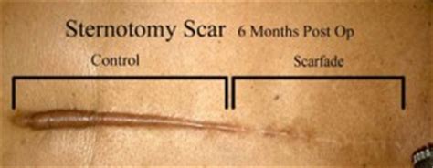 Scar Medicine: Healing 2 Types of Sternotomy Scars - Scarfade