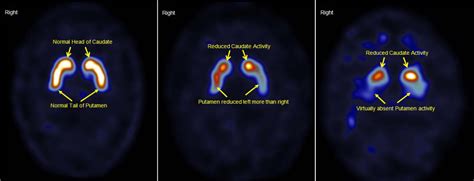 Sensitivity, Specificity, Positive and Negative Predictive Values and Diagnostic Accuracy of ...