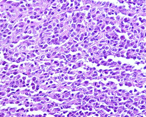 Clear Cell Sarcoma (Melanoma of Soft Parts)