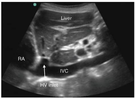 Inferior Vena Cava Ultrasound