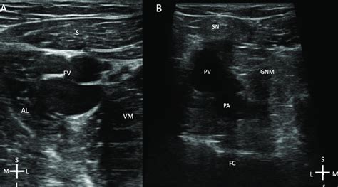 A. Ultrasound image of adductor canal block. S; Sartorius; AL, Adductor ...