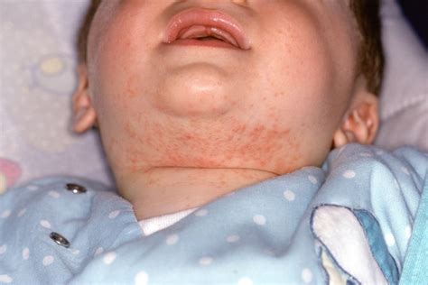 Disease Severity in Pediatric Atopic Dermatitis Linked to Nasal, Skin ...