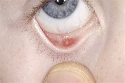 Cyst (chalazion) on eyelid - Stock Image - M155/0595 - Science Photo ...