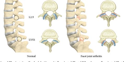 Figure 4 from Lumbar Facet Joint Arthritis Is Associated with More ...