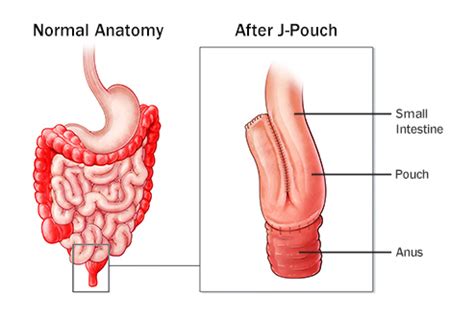 SURGERY FOR ULCERATIVE COLITIS | Colon