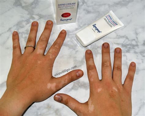 Vitiligo Hand Treatment: Supergoop! Forever Young SPF 40 Hand Cream Review - Mindful Beauty ...