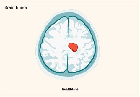 Brain Cancer Causes