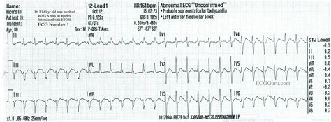 Sinus Tach vs SVT In An Inebriated Patient | ECG Guru - Instructor Resources