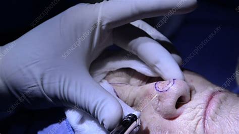 Skin cancer nose surgery, anaesthetic - Stock Video Clip - K002/9717 - Science Photo Library