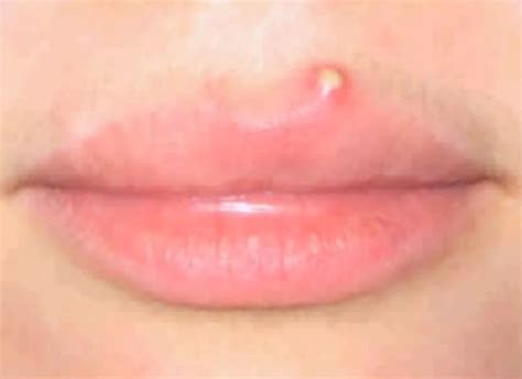 Pimple on lip line | HubPages