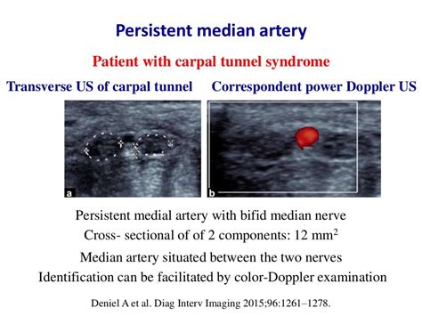 Ultrasound of carpal tunnel syndrome