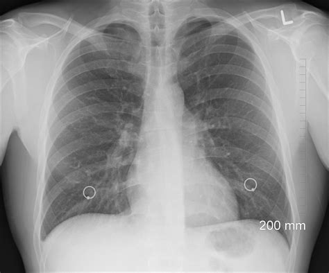 What Does Fluid On The Lung Look Like On An X Ray at Patricia Ledbetter ...