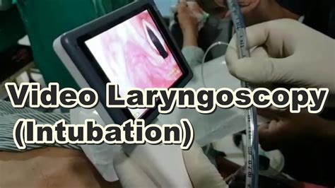 Video Laryngoscopy | Endotracheal Intubation | Laryngoscopy | General Anesthesia | Bougie Wire ...