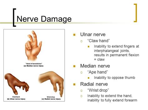 Pin on peripheral nerve | Median nerve, Radial nerve, Physical ...