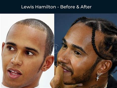 Lewis Hamilton - Hair Transplant Before & After | Black hair transplant, Hair transplant ...