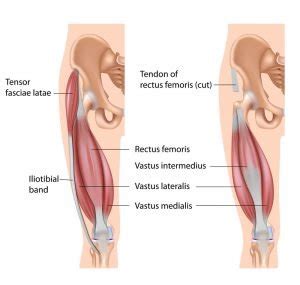 Avulsion fracture: Do I have it? What is the best treatment?