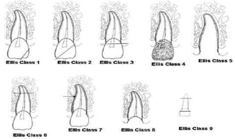 Tooth Fracture MCQ - Focus Dentistry