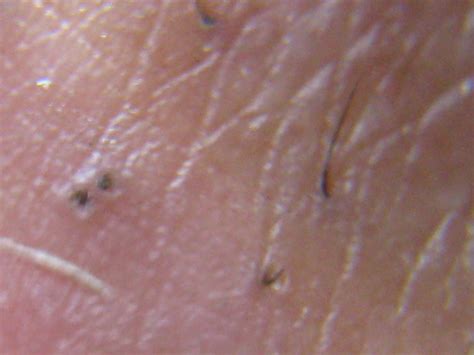 What is Morgellons Disease? | Perfect Therapy