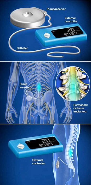 Pin on Surgical Procedures at Southeastern Spine