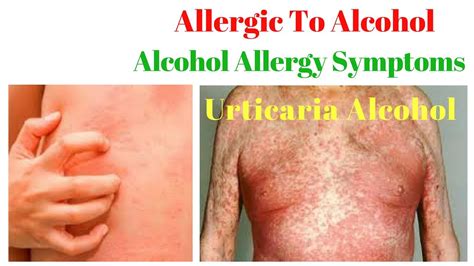 Alcohol allergy - Symptoms, Rash, Alcohol Allergy Test & Treatment