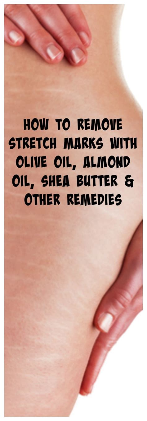 How to Remove Stretch Marks Naturally With Home Remedies and Creams | HubPages