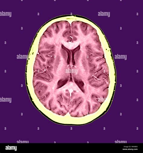 Normal brain, mri scans hi-res stock photography and images - Alamy