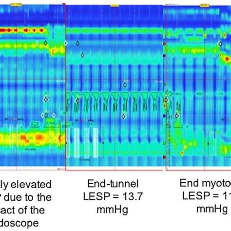 Endoscopic steps of the peroral endoscopic myotomy. Note the presence... | Download Scientific ...