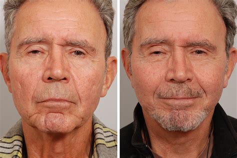 Facelift For Men - Dr. David Rosenberg