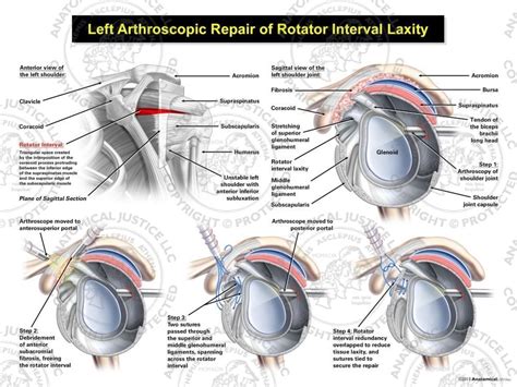 Left Arthroscopic Repair of Rotator Interval Laxity