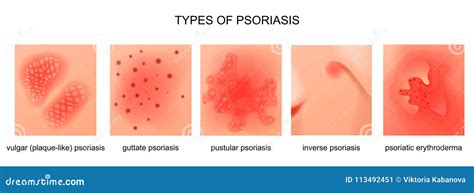 Types of psoriasis stock vector. Illustration of infection - 113492451