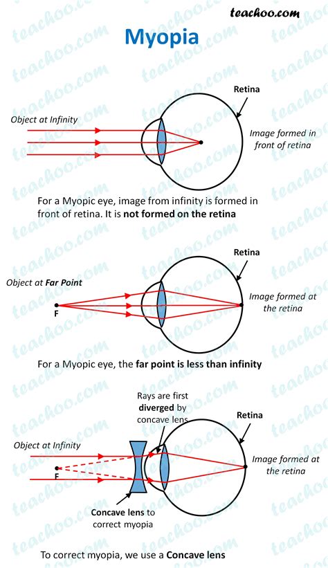 Defects of Vision - Myopia, Hypermetropia, Presbyopia - Teachoo