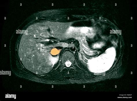 Adrenal Pheochromocytoma, MRI Stock Photo - Alamy