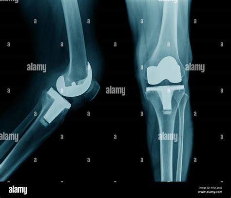 x-ray hip replacement or total knee arthroplasty AP and lateral view ...