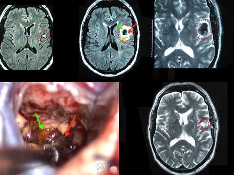 Cavernoma Surgery | Best Cavernoma Surgeon | Cavernous Malformation ...