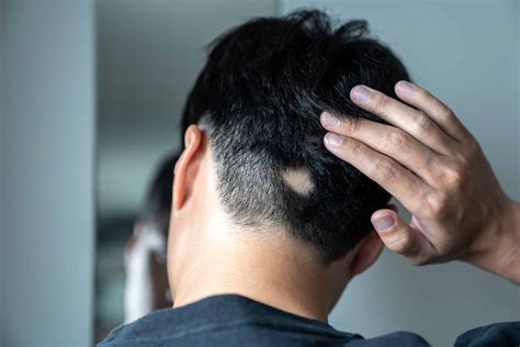 What To Know About Alopecia Areata - Hamblin Dermatology