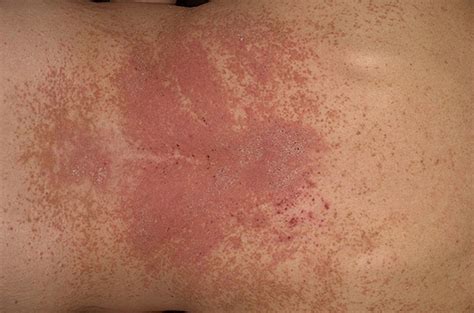 Dermatitis Herpetiformis - Pictures, Symptoms, Causes, Treatment