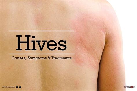 Hives - Causes, Symptoms & Treatments - By Dr. Shivashankar B. Sajjanshetty | Lybrate