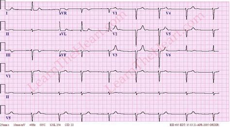 Atrial Fibrillation with Bradycardia ECG (Example 3) | Learn the Heart