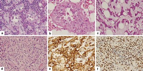 Hemangioendothelioma (hemangiosarcoma) - Pathology - Orthobullets