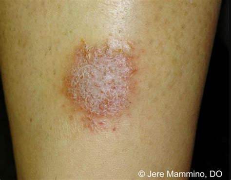 Fungus Among Us? Dermatophyte Infections, Mimickers,… | Relias Media