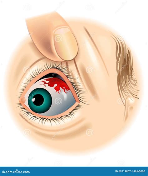 Subconjunctival Hemorrhage Stock Photo - Image: 69719867