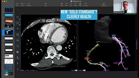 Cleerly Scan - Do you have "fatty" plaque that increases your risk of heart attack? - YouTube