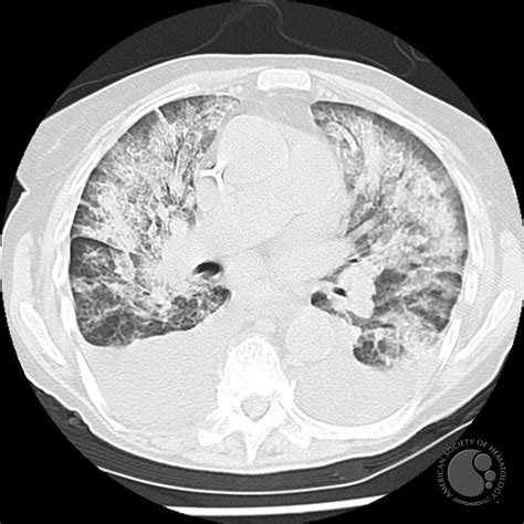 Fungal pneumonia - 1.