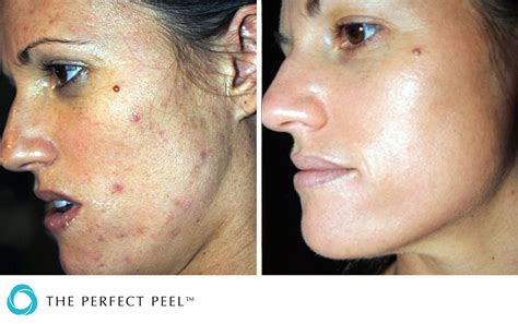 Chemical Peels - Renew Medical Aesthetics