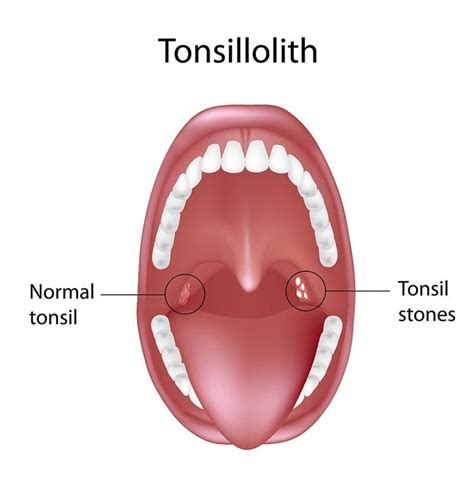 What Causes Tonsil Stones: Symptoms & Removal