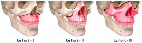 LEFORT FRACTURAS PDF