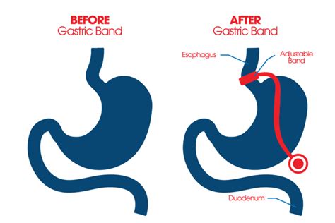 Gastric Band - Bariatric Surgery Tijuana - Stop Obesity