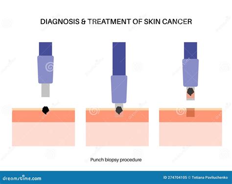 Punch Biopsy Procedure Cartoon Vector | CartoonDealer.com #274704105